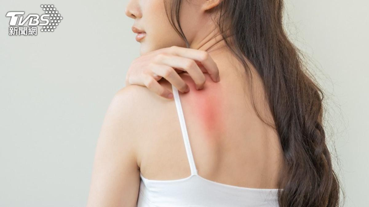 傳染力超強!50歲女麻疹進ICU 出國「做1事」自保