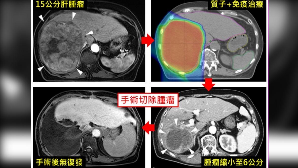 婦肝癌剩半年...醫用1招讓15公分腫瘤縮小 2年未復發