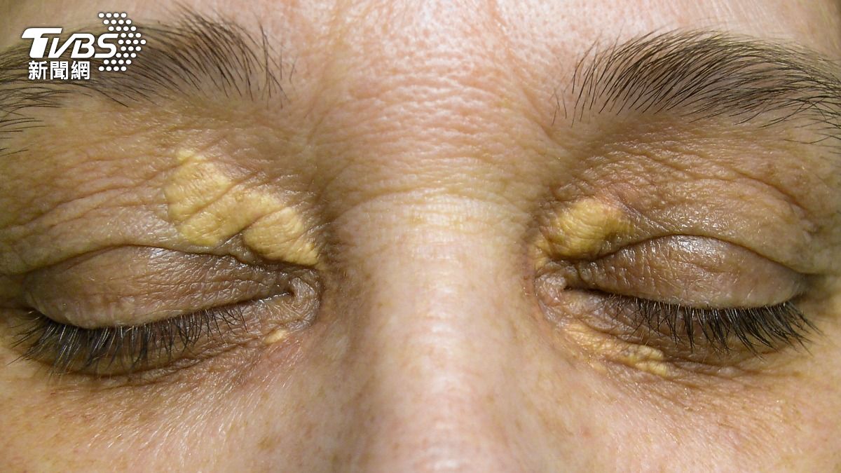 壯男健身突倒地「心肌梗塞」!醫曝臉上2徵兆:壞膽固醇過高