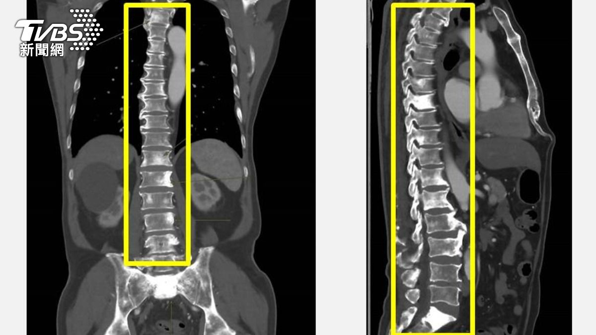 背痛忍一個月!台中男狂熱敷吃止痛藥 醫揪出攝護腺癌
