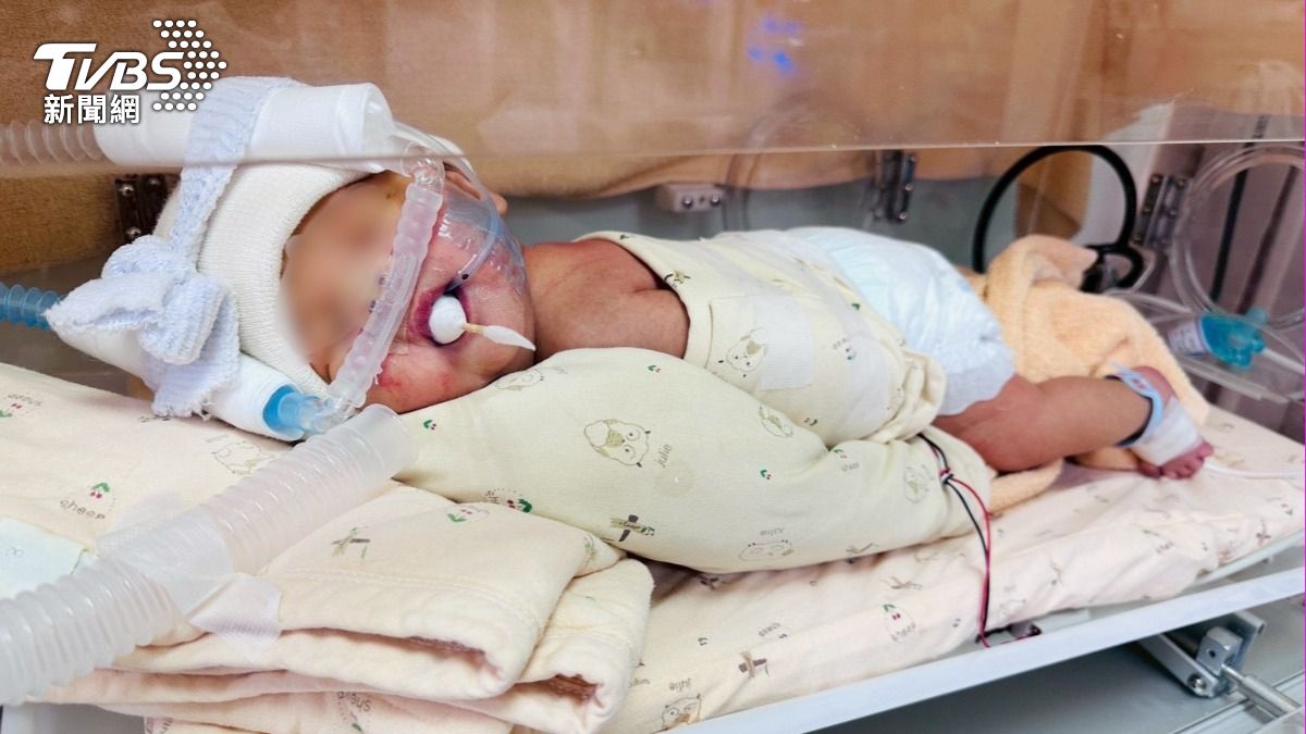 台中男嬰只哭2聲沒動靜!新手爸當場愣住 醫揪先天性肺炎