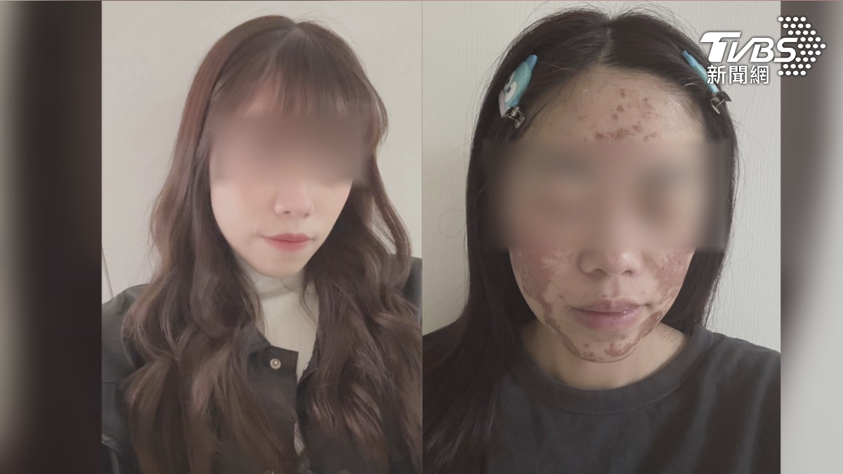果酸煥膚變災難! 濃度「40%變70%」女子臉嚴重灼傷