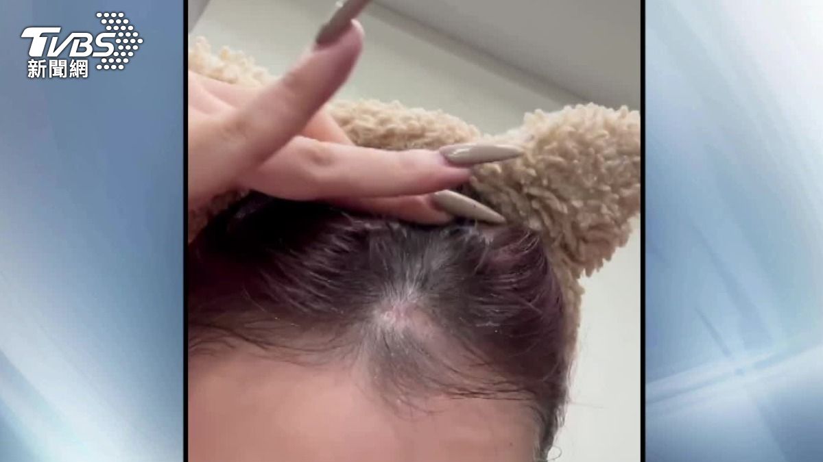 戴假髮「髮網害禿頭」?女驚恐得植髮 醫曝這原因機率高