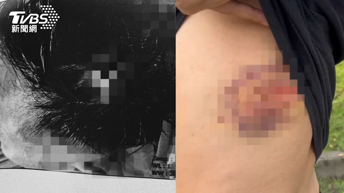 宜蘭情侶爆口角!男子遭女友哥「鋁棒狂毆」 頭縫14針濺血