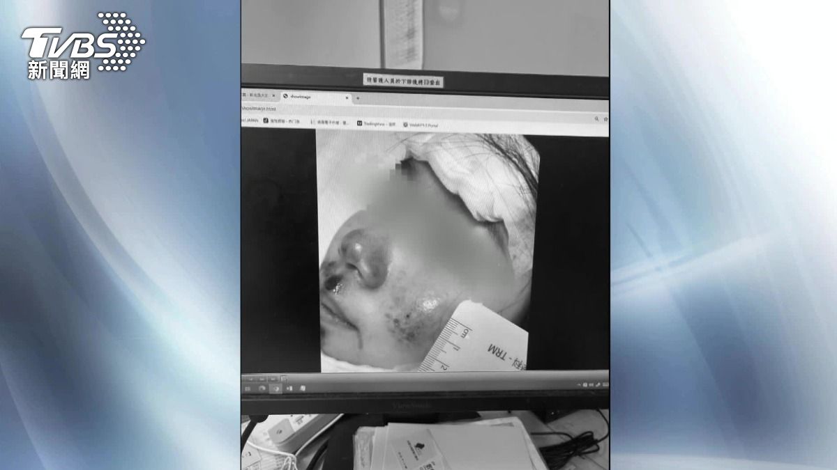 車禍留疤做醫美被拒賠!她氣炸控保險員「本來說有收據就理賠」