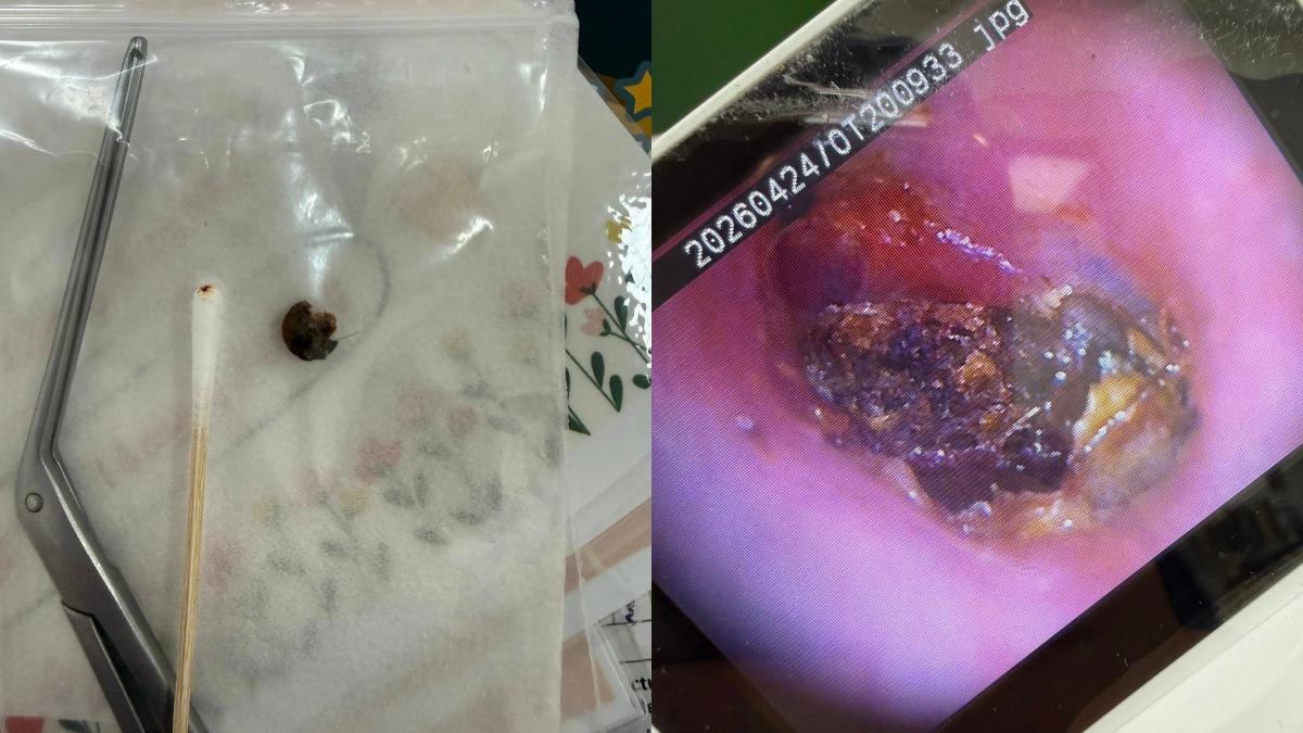 愛用棉花棒挖耳!男耳悶「一挖掉出巨型黑垢」曝:求醫全卡在這關