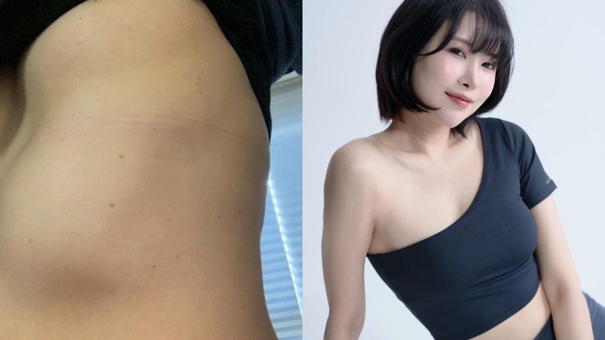 女星隆乳升級D波!填充物走山掉肋骨「慘變4個胸部」 她爆副作用勸世