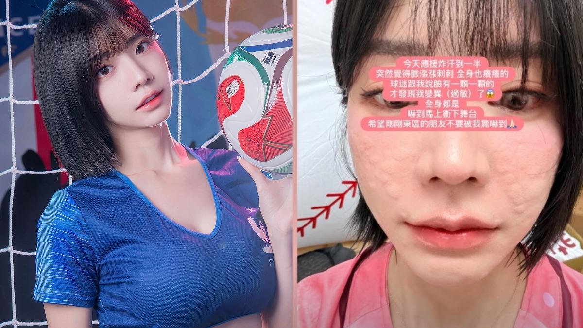 中職最正MC出事了!應援一半「整臉長滿顆粒」急衝下台 發病原因曝光