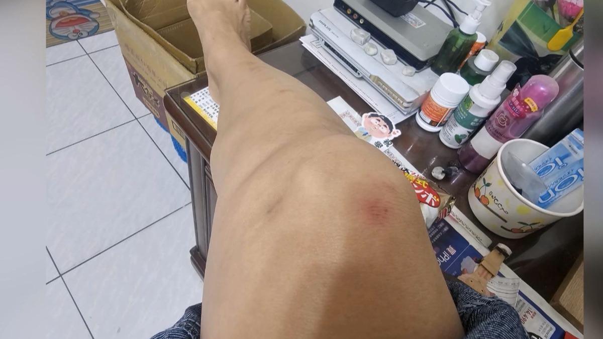 女踩診所斜坡慘摔! 提告不起訴 不滿檢方妄論「健康因素」
