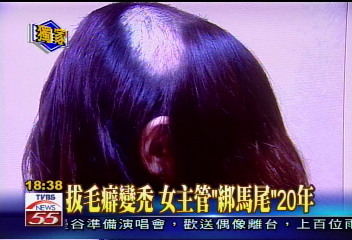 獨家 拔毛癖變禿女主管 綁馬尾 年 禿頭 Tvbs新聞網