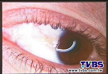 光強不戴太陽眼鏡女眼竟長 贅肉 眼睛 Tvbs新聞網