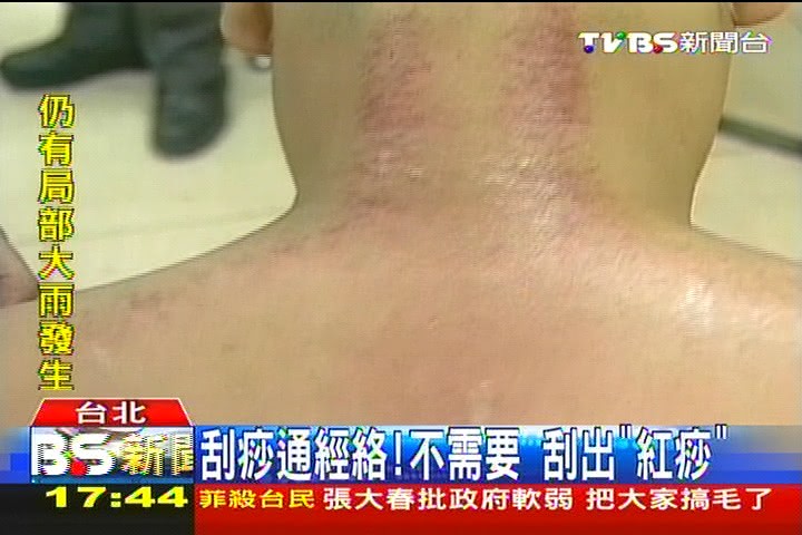 刮到滿身傷! 「無痕」刮痧顛覆印象│TVBS新聞網