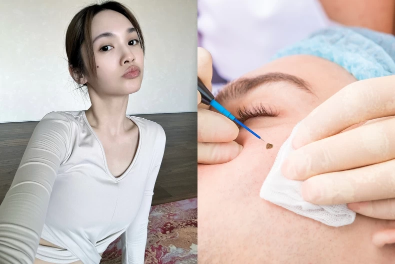 臉上這4顆痣最破財又招小人！專家推薦「點痣方法」揭曉，助你輕鬆甩開衰運！