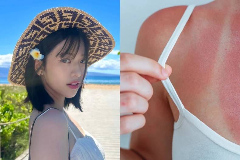 曬傷怎麼辦
