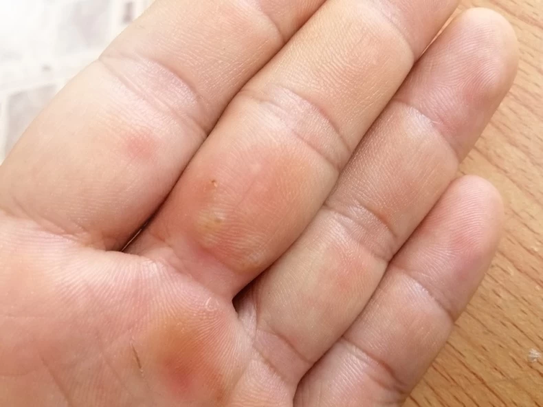 汗皰疹