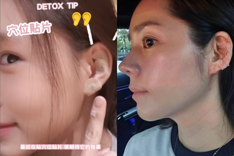 耳穴貼