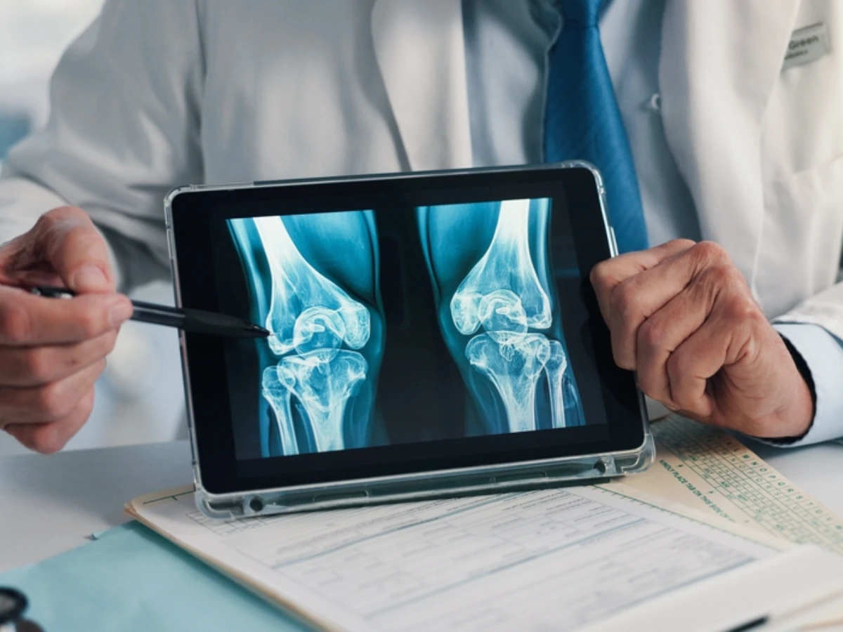 醫師警告「骨裂」不可輕忽