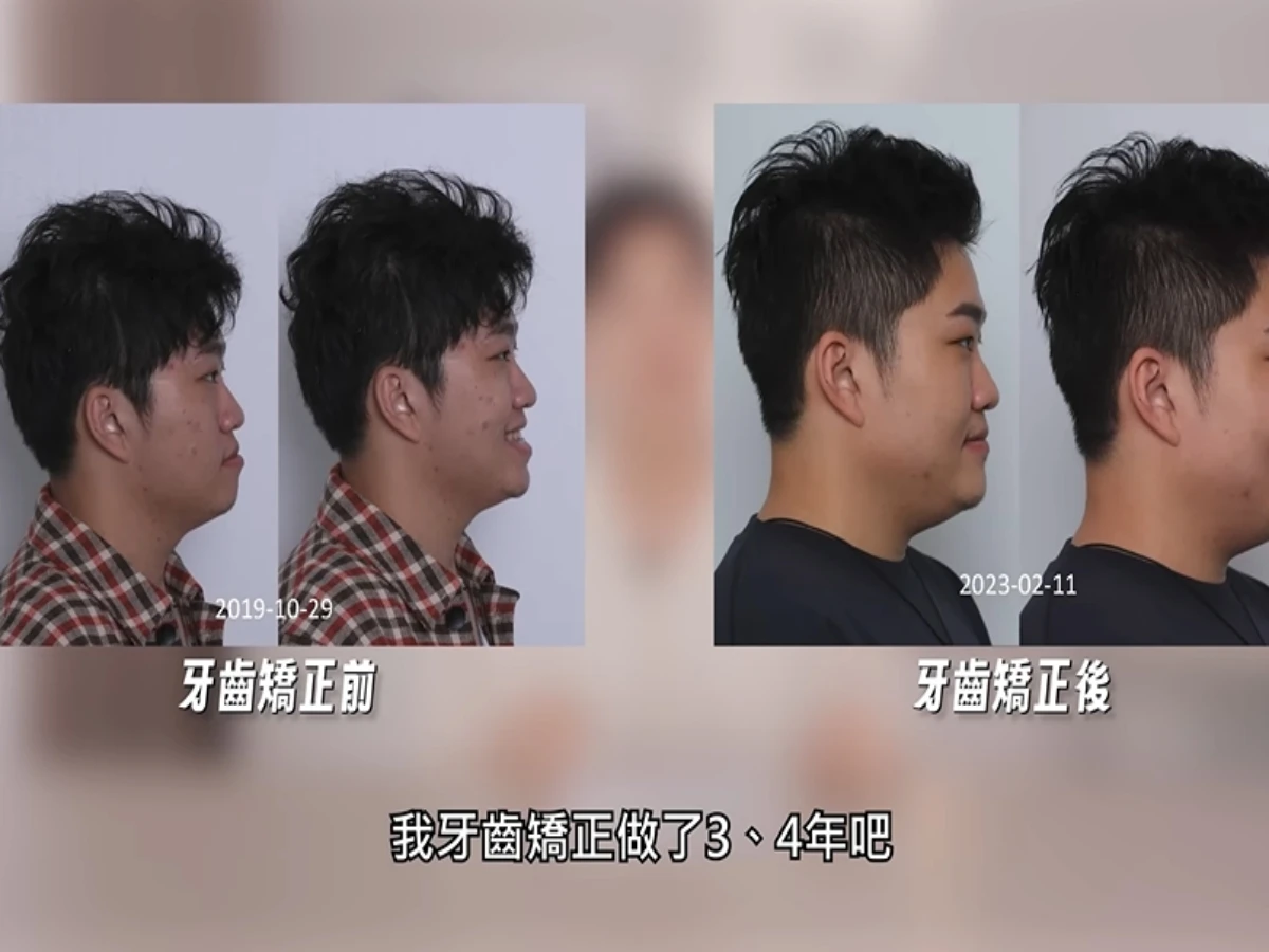 牙齒矯正：影響臉型的關鍵投資