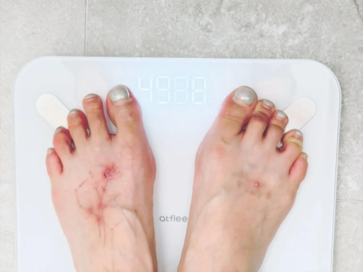 泫雅一個月快速減肥，腳上傷口引熱議