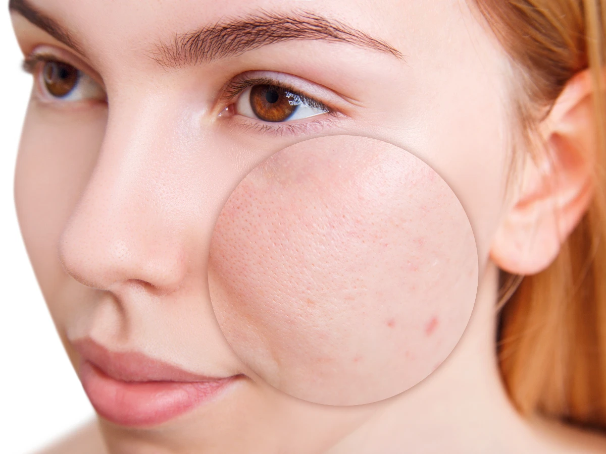 肌膚缺水會致毛孔粗大？