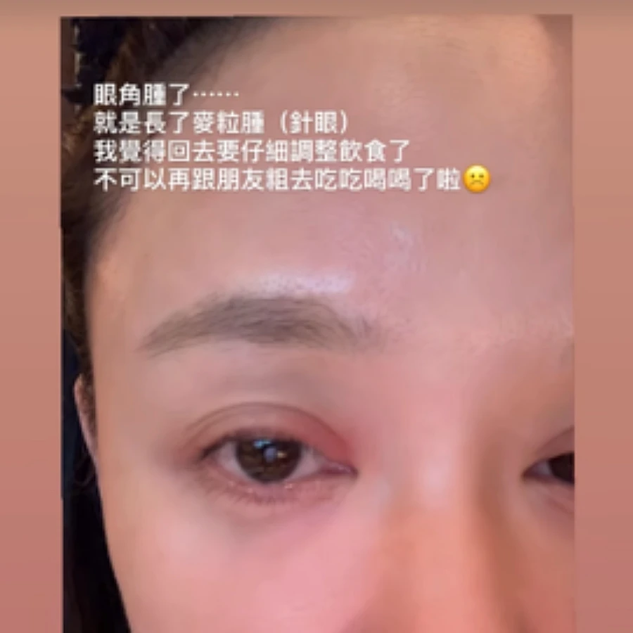 陳喬恩素顏照曝光！自曝臉上長了怪物